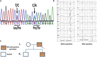 Studying Brugada Syndrome With an SCN1B Variants in Human-Induced Pluripotent Stem Cell-Derived Cardiomyocytes